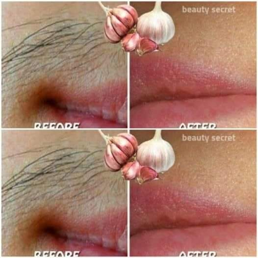 Say Goodbye to Unwanted Hair Using Garlic